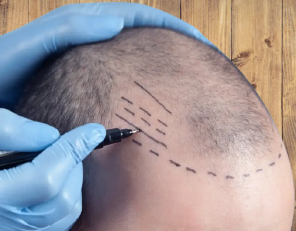 hair transplant