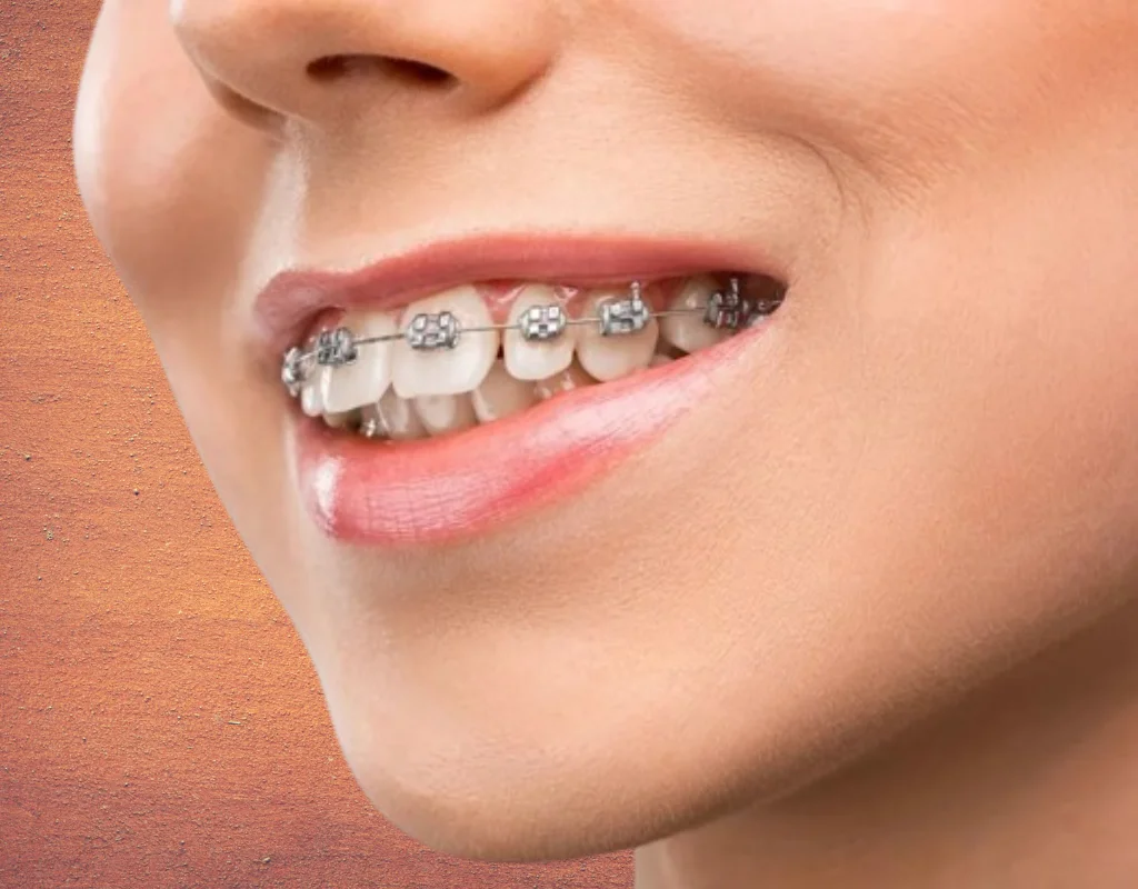 dental braces