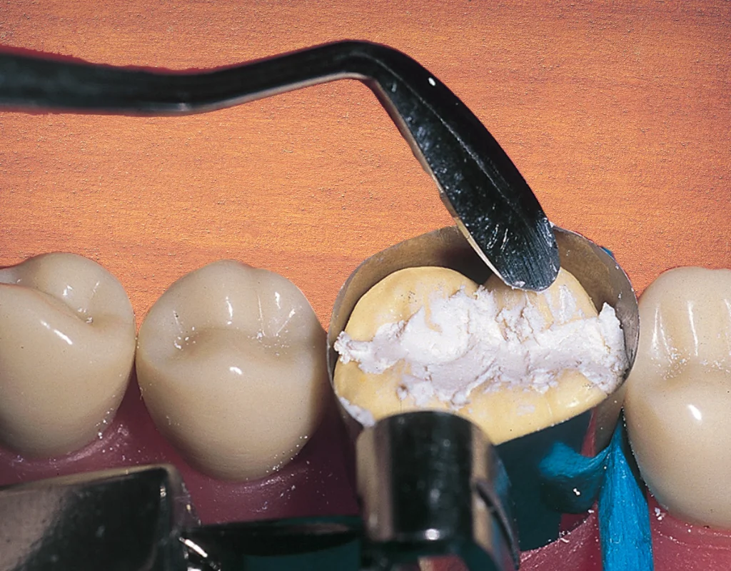 dental cement filling