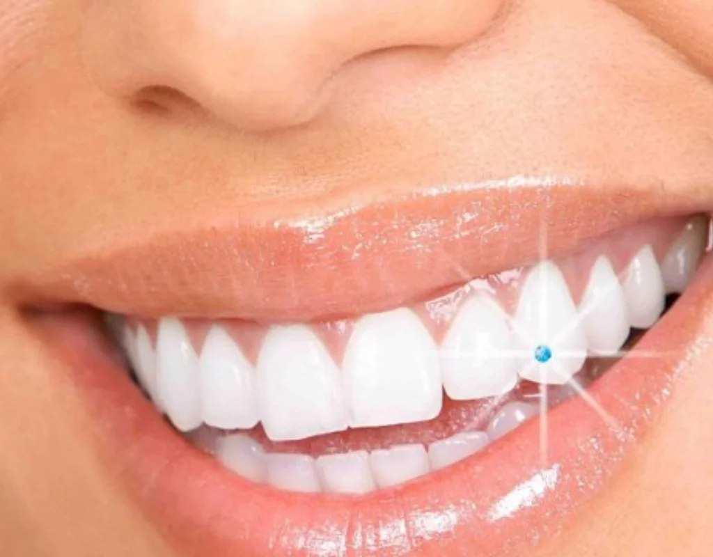 dental jewellery