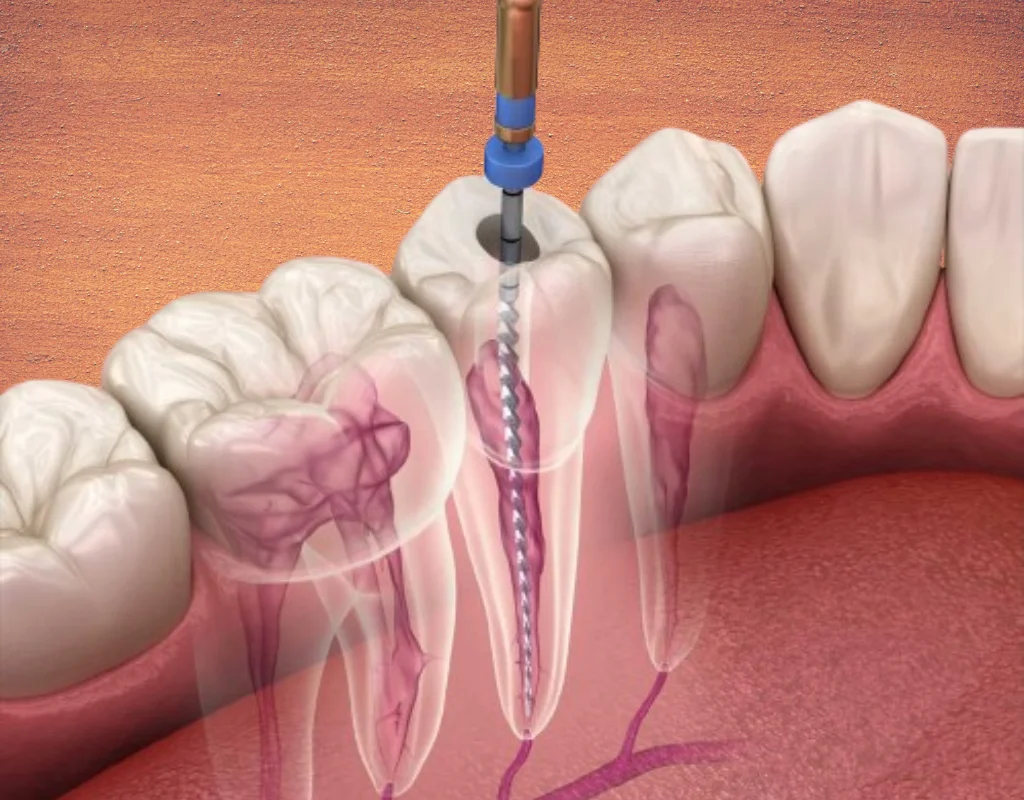 root canal